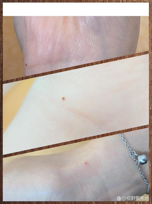 硃砂痣:從醫學解析到文化寓意,深度剖析其神秘面紗 1 硃砂痣