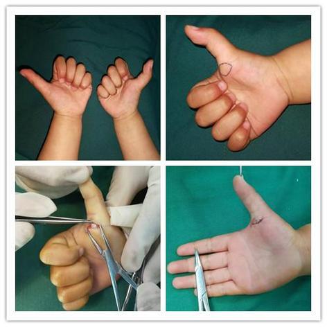 板機指手術多少錢