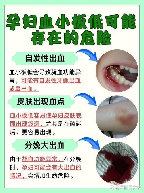 血小板低下會死嗎?從成因、風險到治療,深度解析血小板數值異常的生與死 1 血小板低下會死嗎