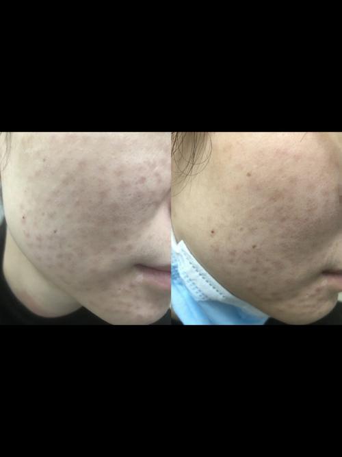 如何清除臉上肉芽