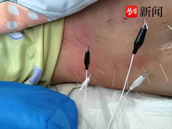 抽脊髓液要躺多久?深入解析術後恢復關鍵與注意事項 1 抽脊髓液要躺多久