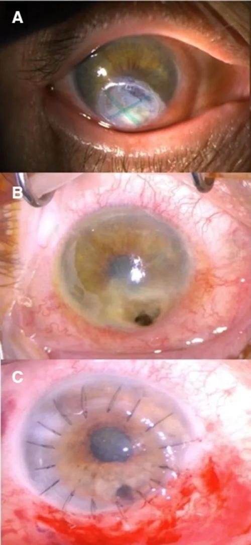 缺乏維生素A會怎樣