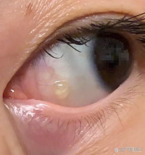 眼睛為什麼會黏黏的