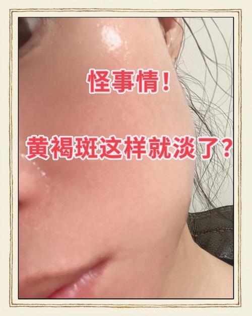 a醇可以淡斑嗎