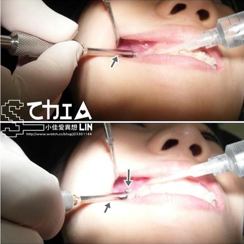 上顎骨釘怎麼清