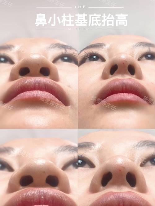 鼻小柱在哪裡?深度解析鼻中柱美學與功能的重要性 1 鼻小柱在哪裡