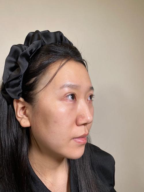 打完玻尿酸可以笑嗎