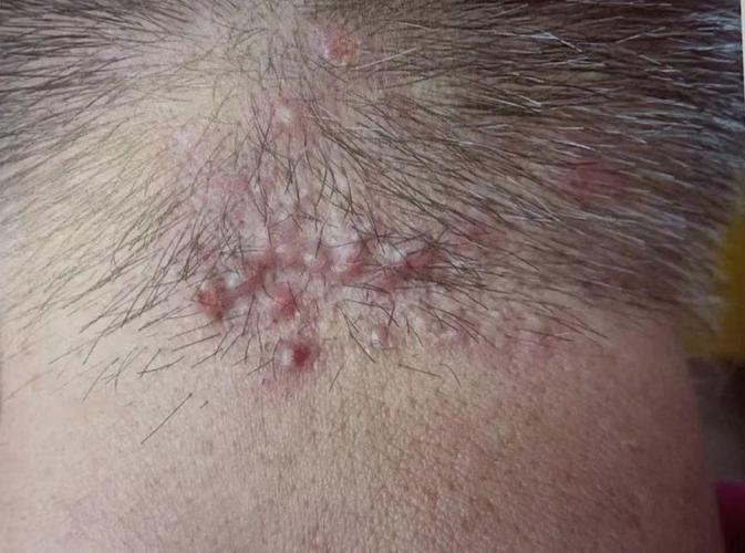 為什麼會摳頭皮