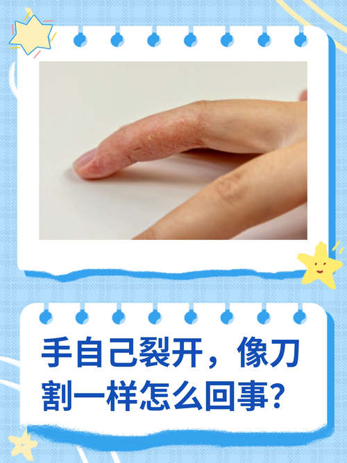 手為什麼一直裂開