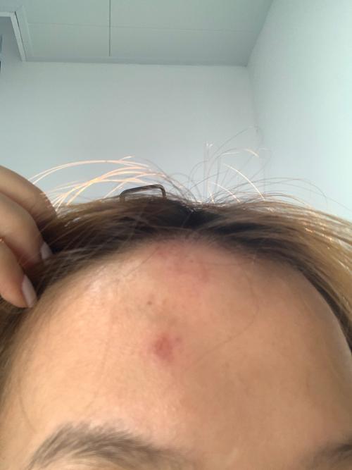 為什麼瘀青會一點一點的