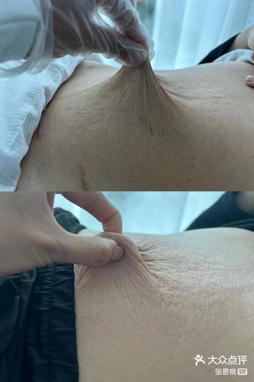 減肥後皮很鬆怎麼辦:重塑緊緻身形,告別鬆垮困擾的終極指南 3 減肥後皮很鬆怎麼辦