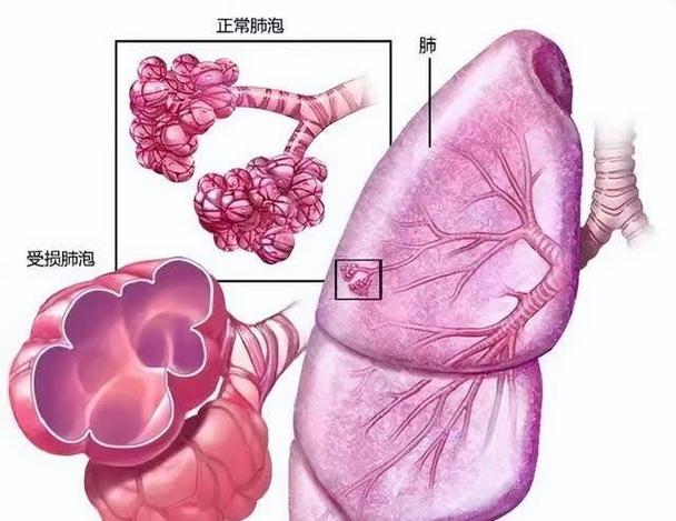 肺泡有什麼用?深入解析呼吸核心「生命之袋」的關鍵功能與運作機制 1 肺泡有什麼用