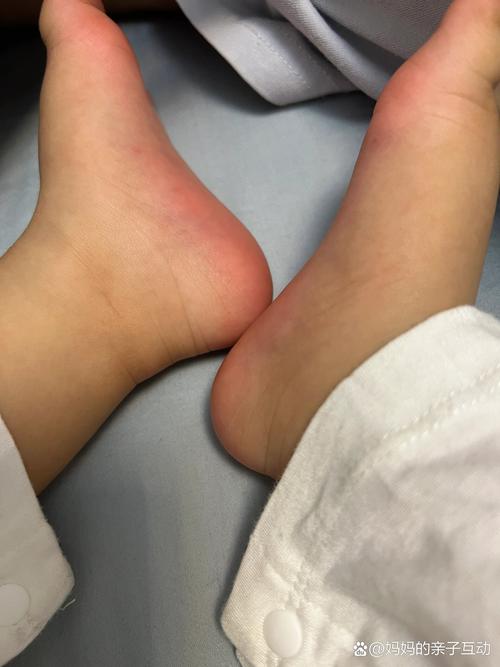 為什麼小孩腳很臭