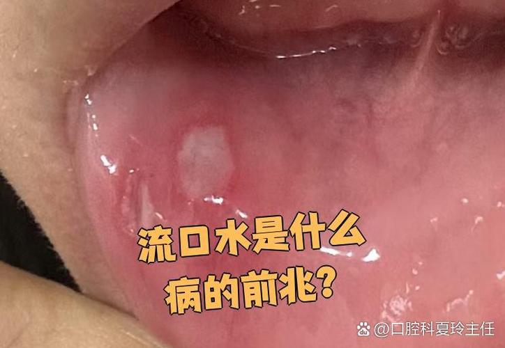 流口水是中風的前兆嗎:深度解析口水過多與中風警訊的關聯性 1 流口水是中風的前兆嗎