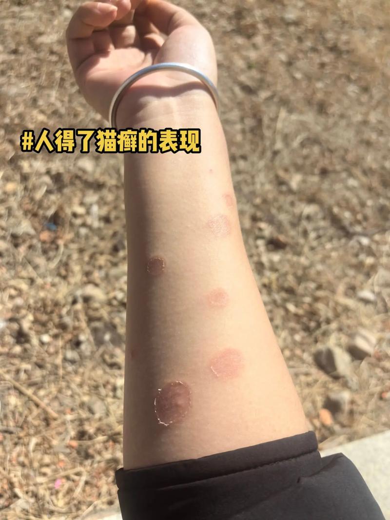 貓癬會人傳人嗎