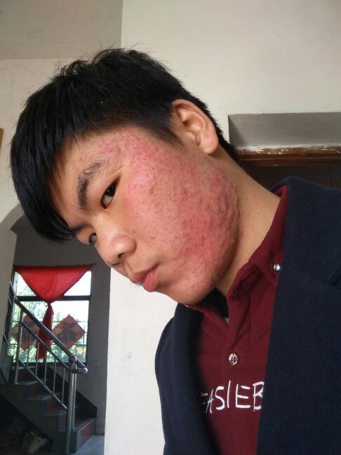 M痘 台灣幾例?深入解析國內猴痘疫情現況與防護之道 1 M痘 台灣幾例