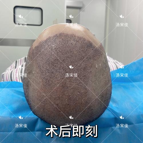 可以用鬍子植髮嗎