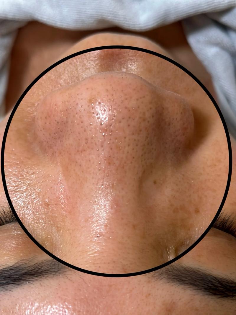 多久要清一次粉刺