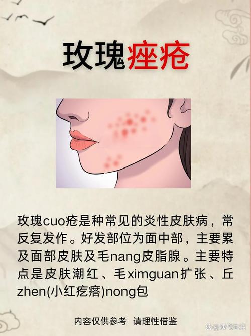 玫瑰痤瘡能根治嗎