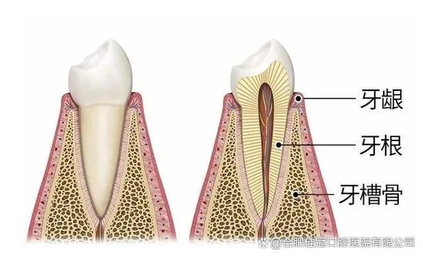 沒有骨頭怎麼植牙?骨量不足的植牙解方與專業分析 3 沒有骨頭怎麼植牙