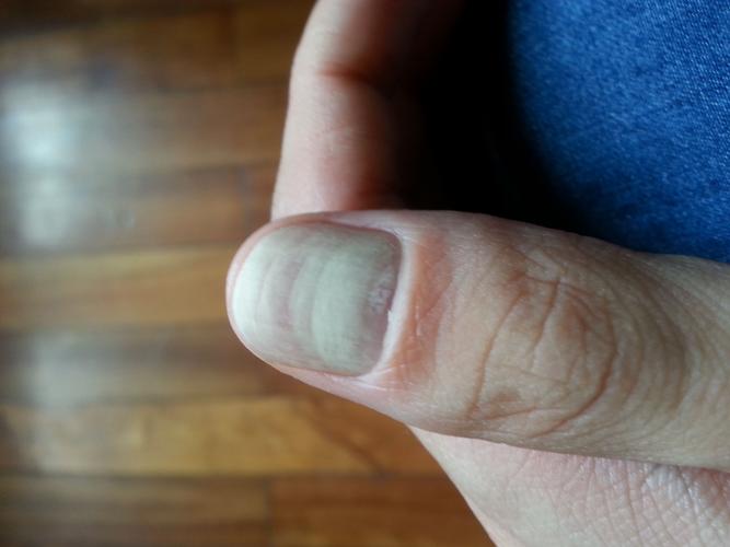 指甲白白的是什麼