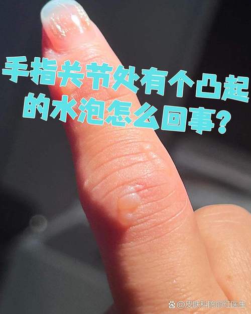 手碰到鹽酸會怎樣