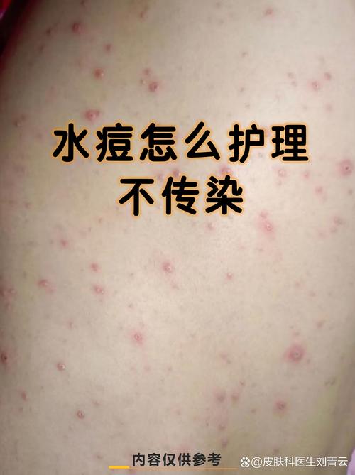 水痘可以抓嗎
