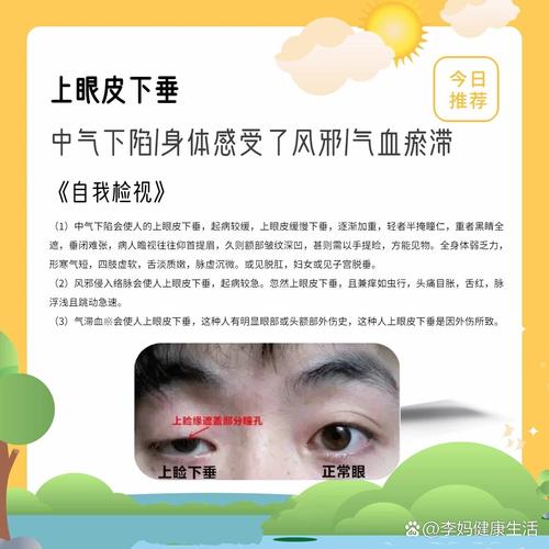 為什麼眼皮會下垂