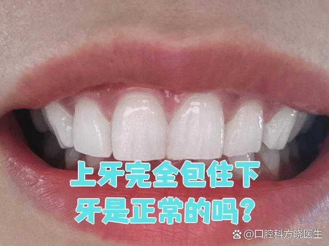齒包是什麼?牙齒矯正迷思一次解惑,找回自信笑容的秘密 3 齒包是什麼