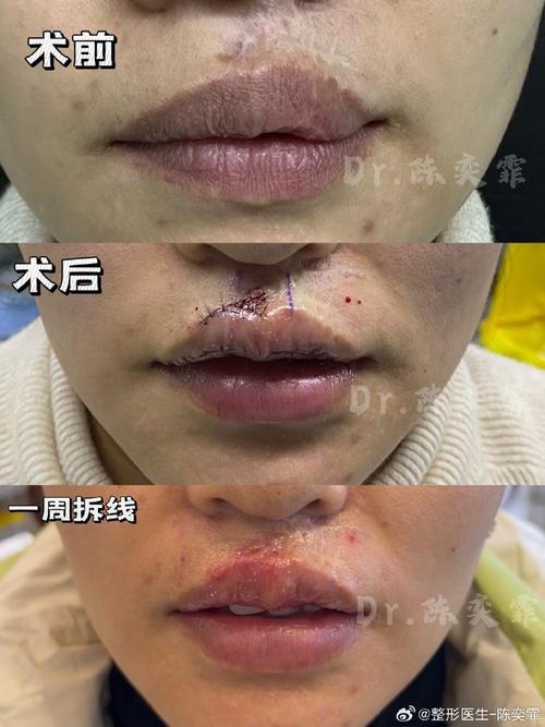 嘴唇受傷會留疤嗎