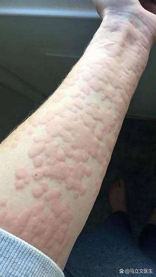 為什麼一直反覆尋麻疹