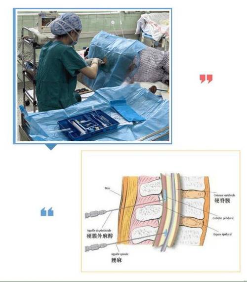 為什麼剖腹不能全麻