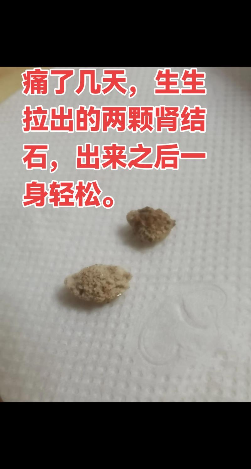 腎結石會自己掉下來嗎