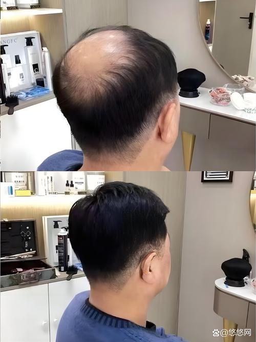 硬水會禿頭嗎