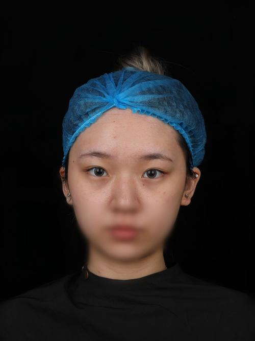 15歲可以縫雙眼皮嗎