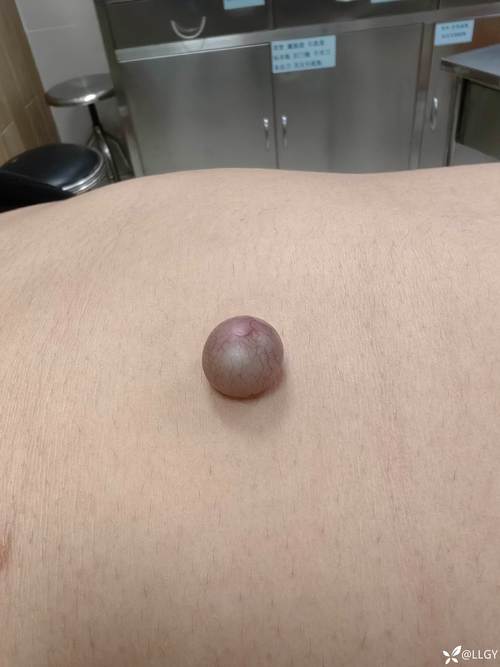 皮樣囊腫會自己好嗎