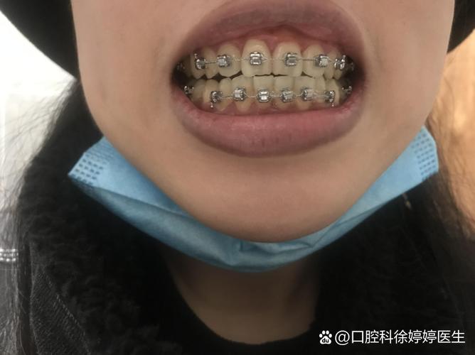 維持器多久沒戴會跑掉
