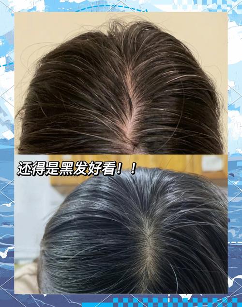 白頭髮可以黑回來嗎