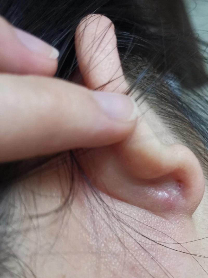 耳洞腫起來會自己好嗎