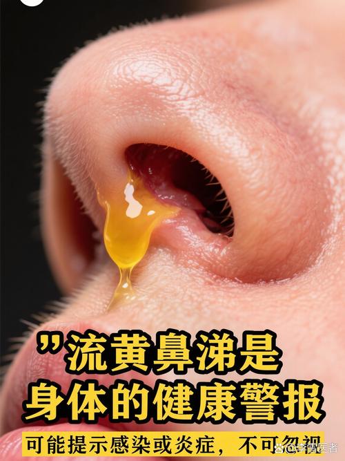 流感會流鼻水嗎