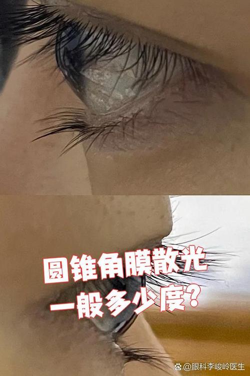 散光400度嚴重嗎