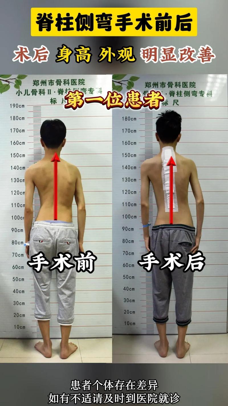 脊椎開刀會癱瘓嗎?深入解析風險、預防與術後照護,幫助您安心面對 3 脊椎開刀會癱瘓嗎