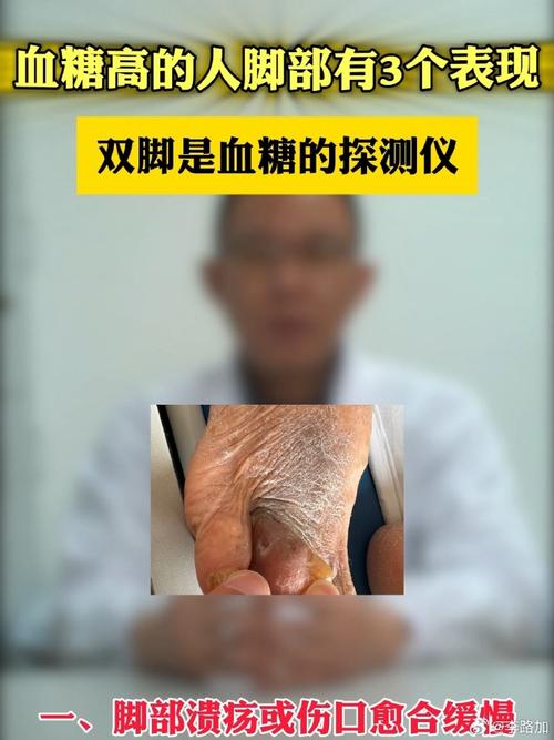 血糖高會有什麼感覺