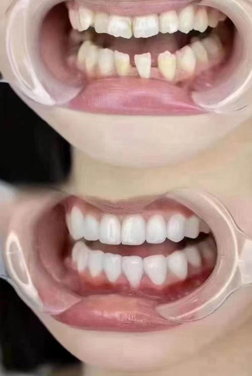 牙齒可以變白嗎?揭開牙齒美白的迷思與科學方法! 1 牙齒可以變白嗎