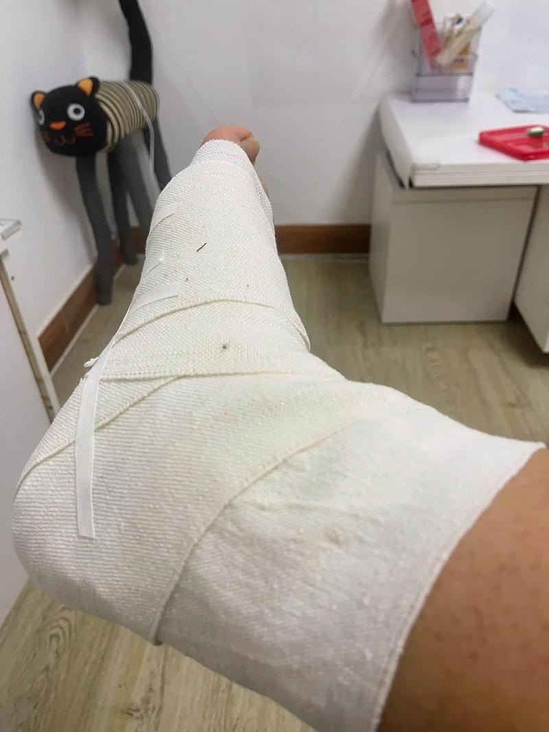 韌帶撕裂傷需要開刀嗎