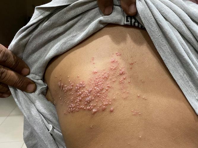 什麼人容易得帶狀皰疹