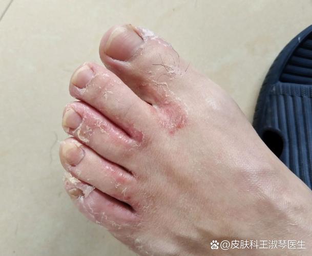 為什麼腳趾甲縫會臭臭的?深入解析原因、預防與改善之道 3 為什麼腳指甲縫會臭臭的