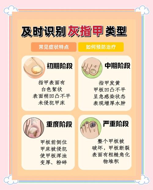 灰指甲怎麼感染的