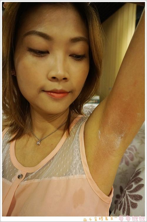 亞歷山大可以永久除毛嗎