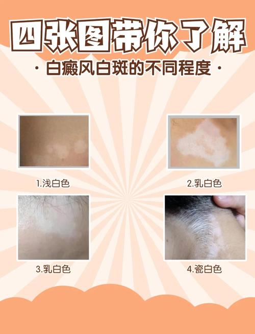 兩個月不曬太陽會變白嗎